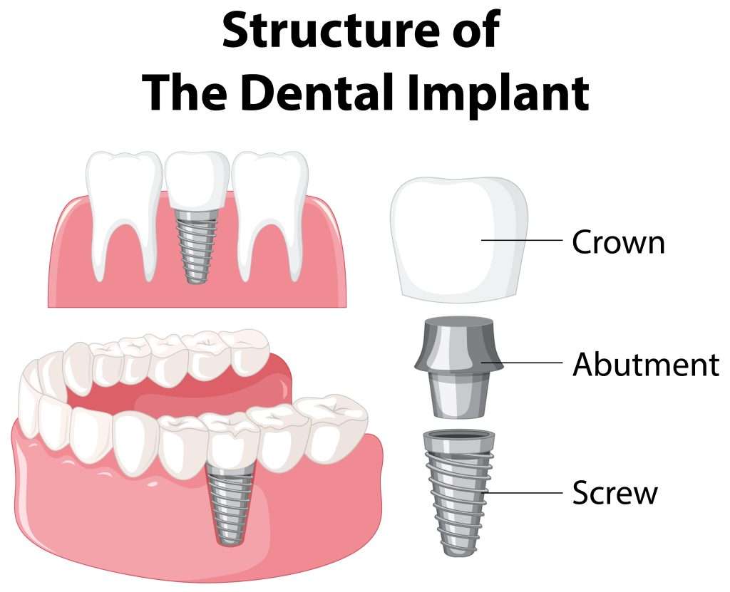 Implantet dentare