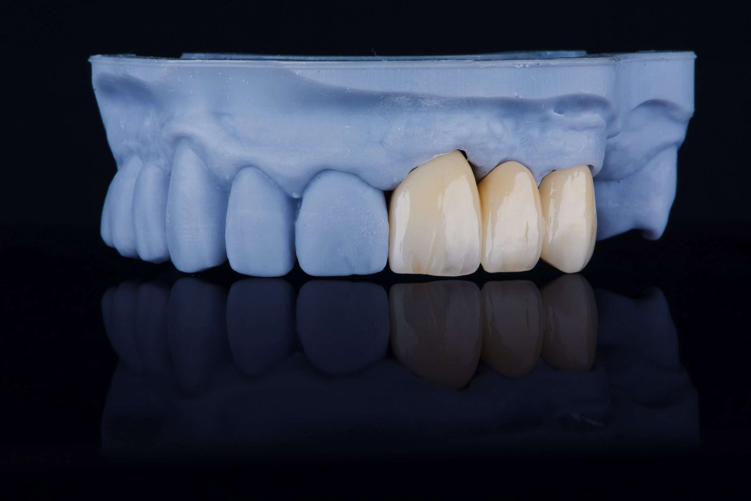 zirconia crown