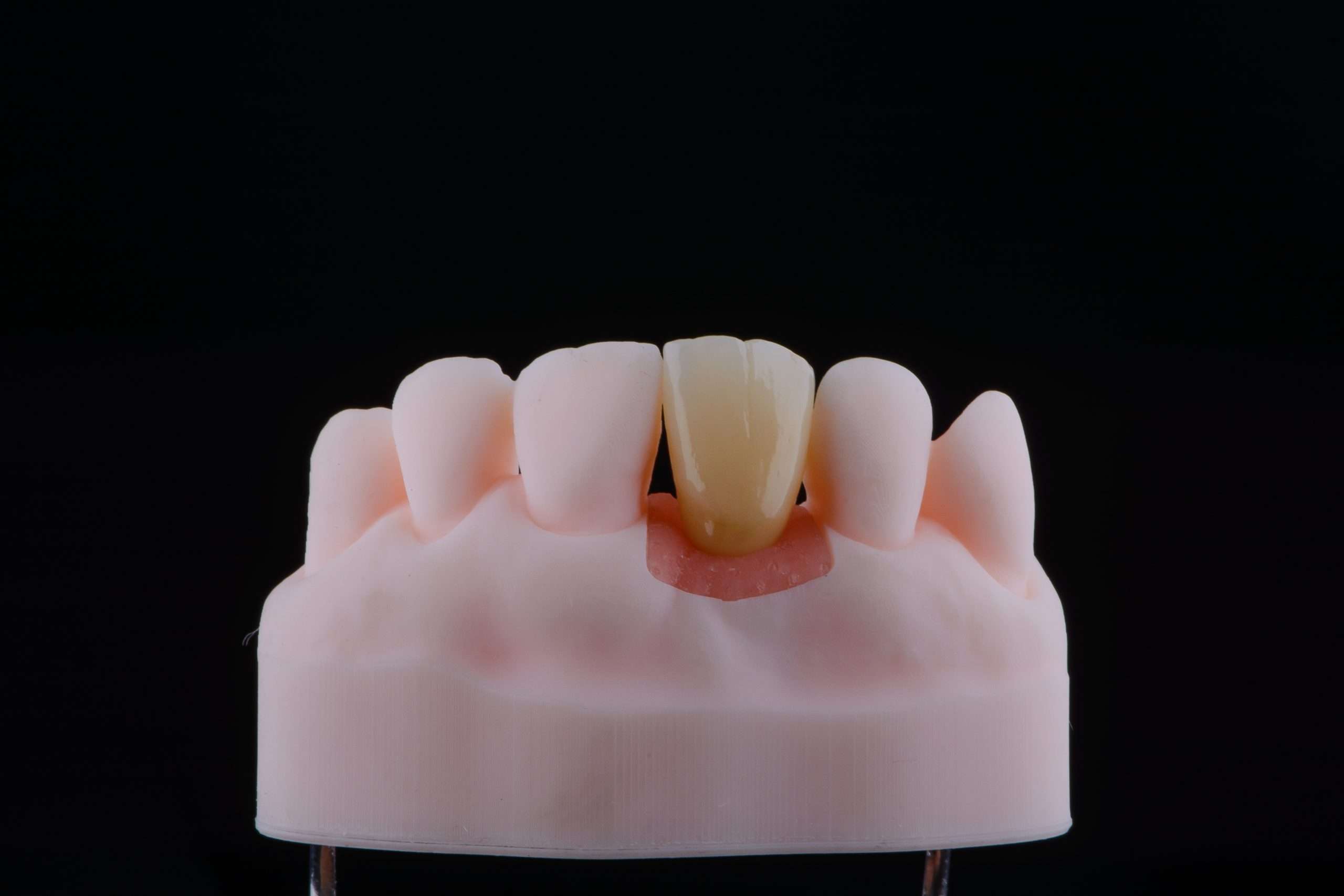 zirconia crown