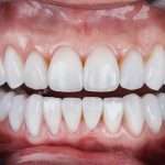 Affordable Zirconia