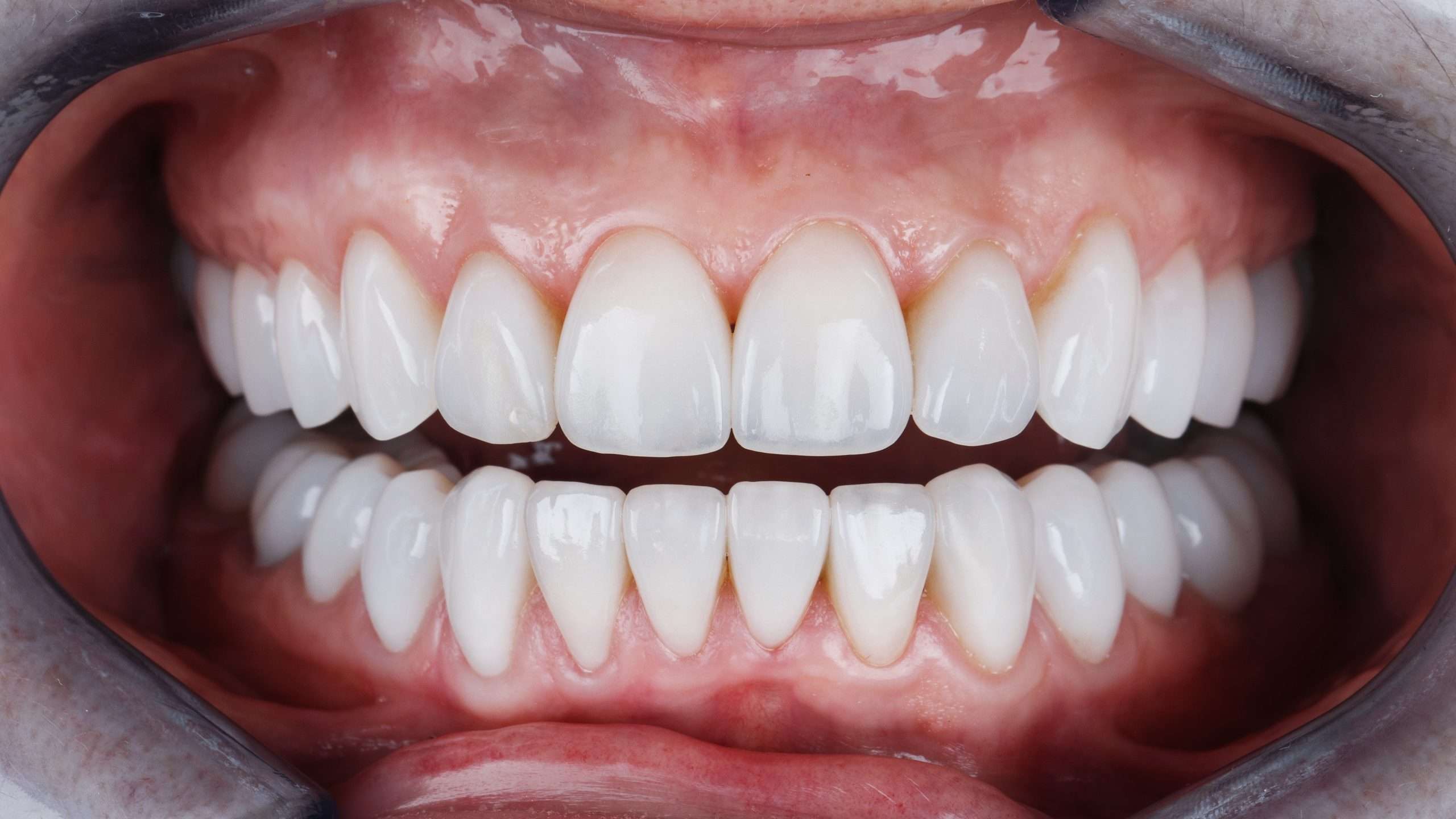 Affordable Zirconia