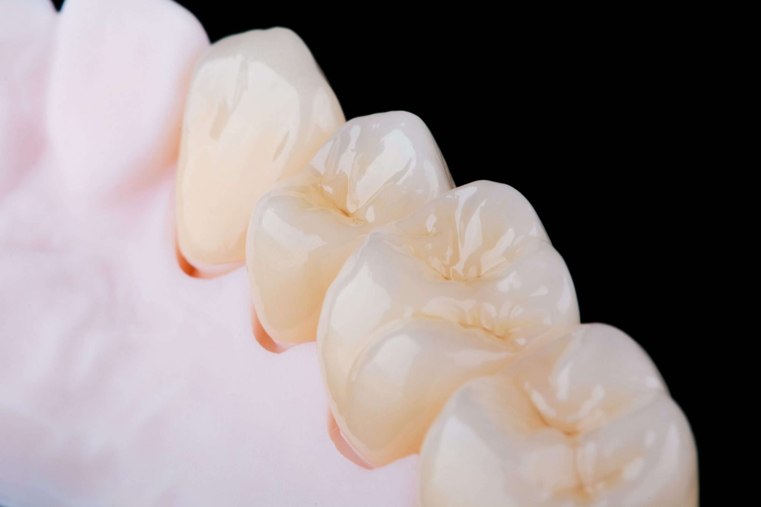 corone dentali singole di alta qualità realizzate in zirconio per la fissazione dei denti dell'arcata superiore.